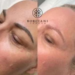 Microblading Removal Laser
