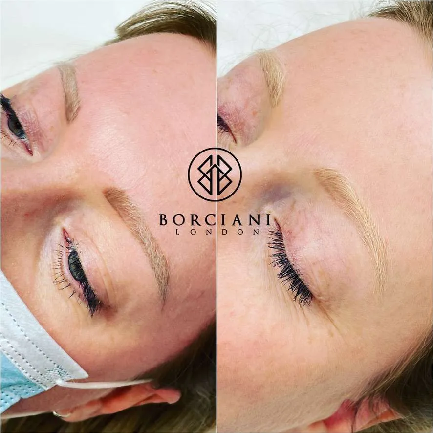 Microblading removal before and after