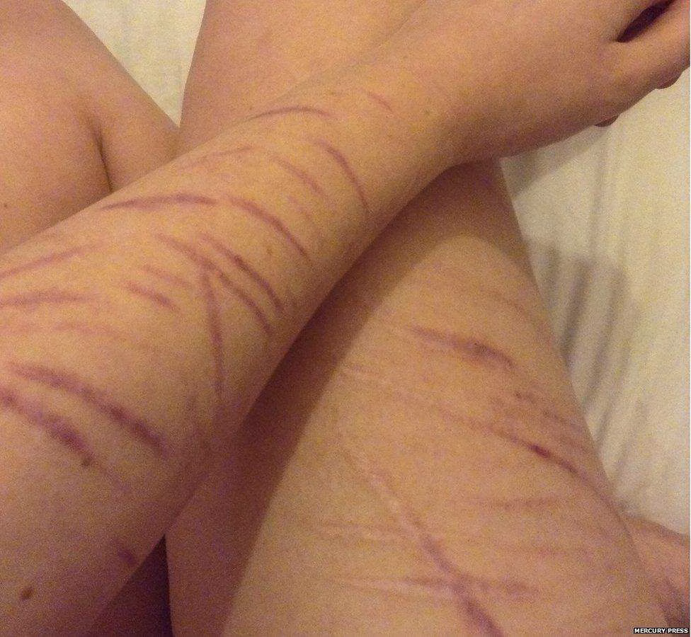 88814885 mpm girl refused alcohol over scars 06