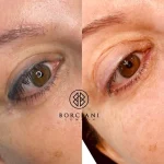 Eyeliner Tattoo Removal