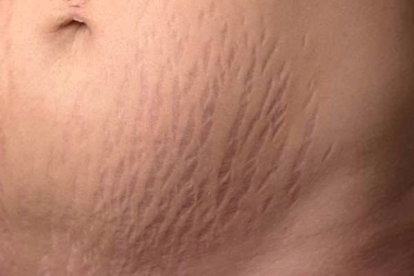 stretch marks