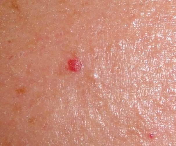 Cherry-Angioma-1.35-MB-cropped2 cherry angioma