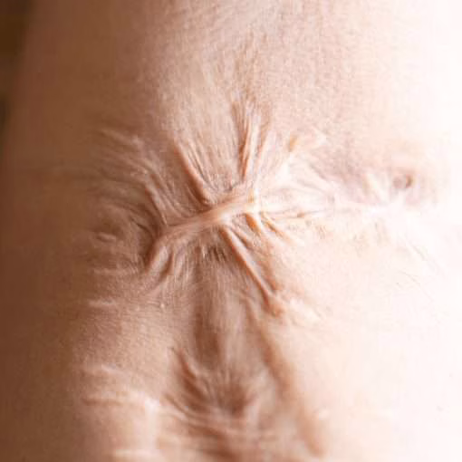 Contracture Scar