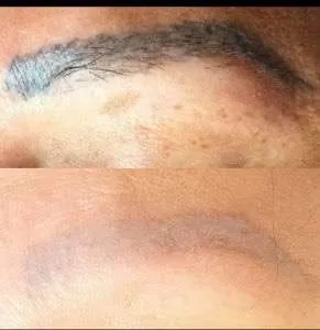 Laser removal equipment
