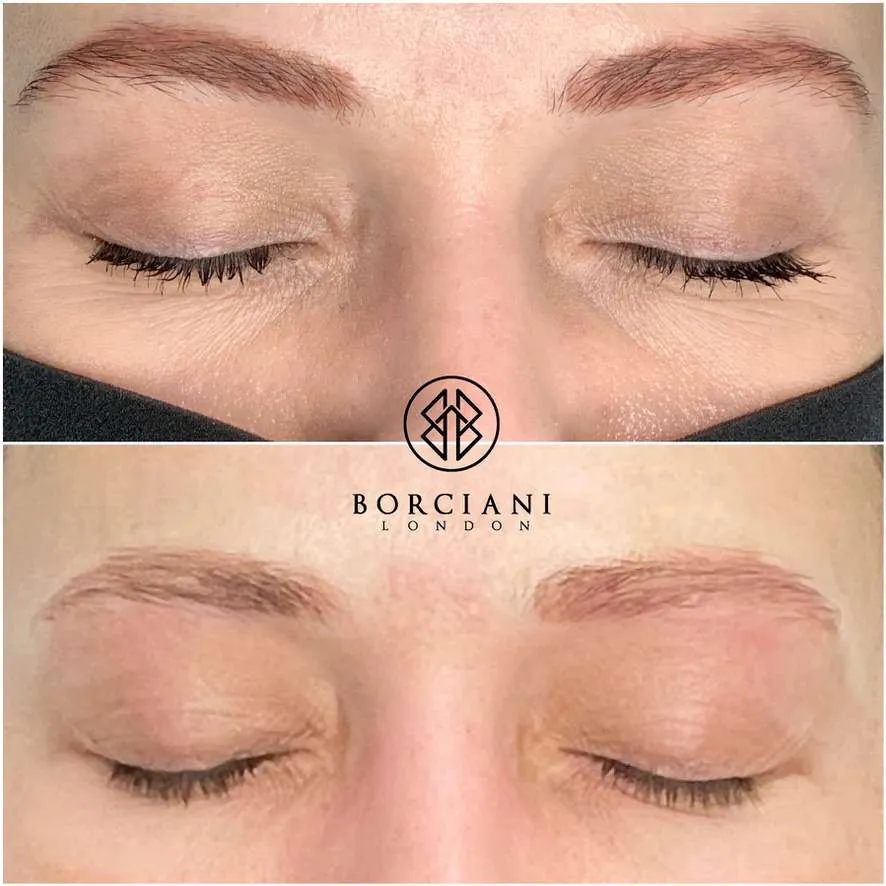 Saline removal on brows