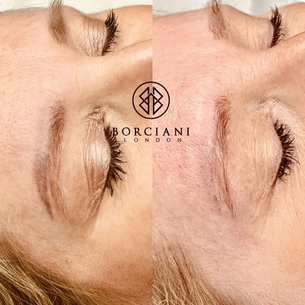 Close-up of healed removal