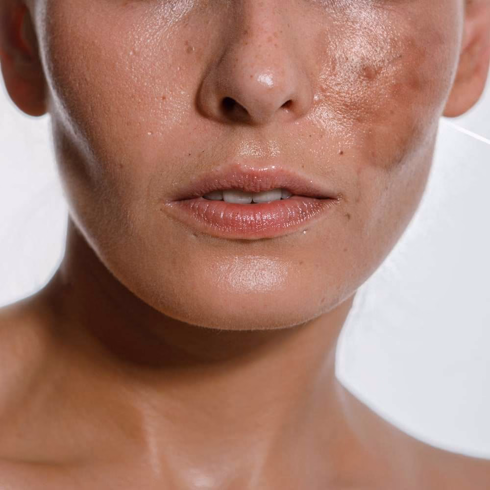 Lady with Melasma