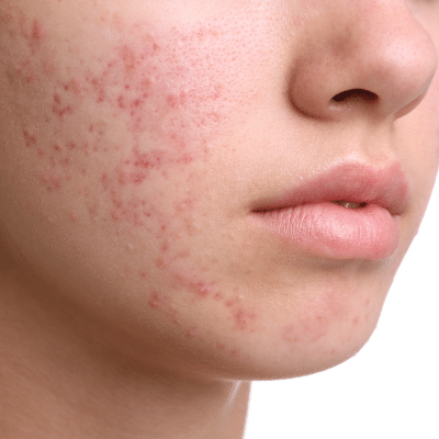 Acne