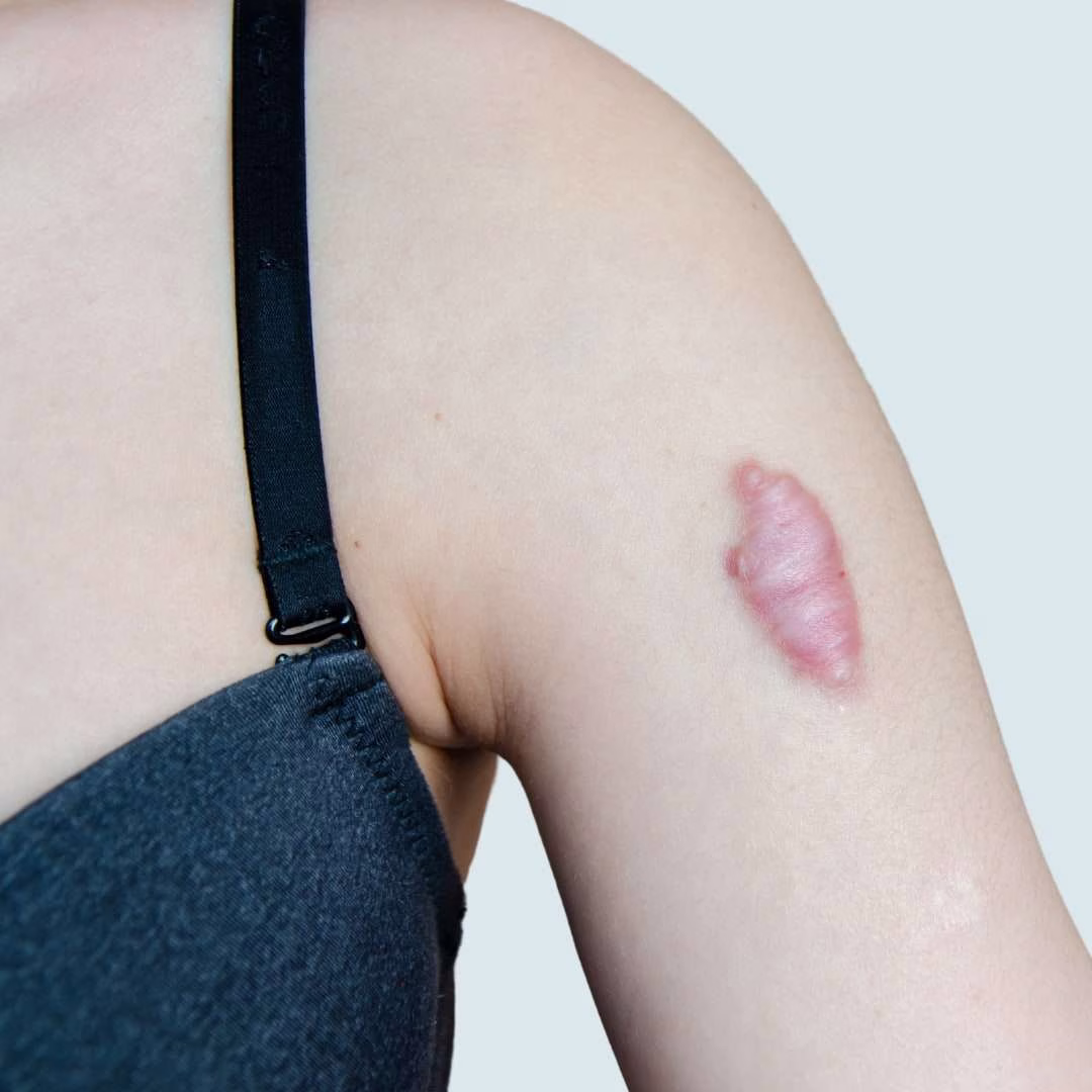 Understanding-Keloid-Scars (1)