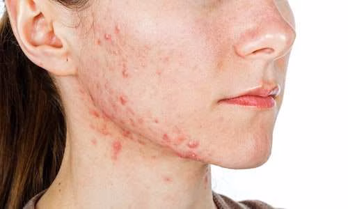 acne