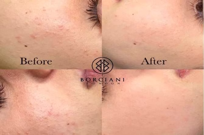 acne1 acne1
