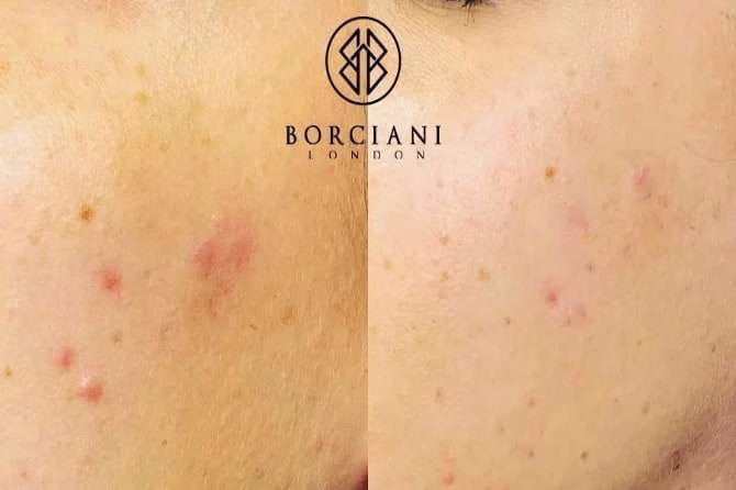 acne2 acne2