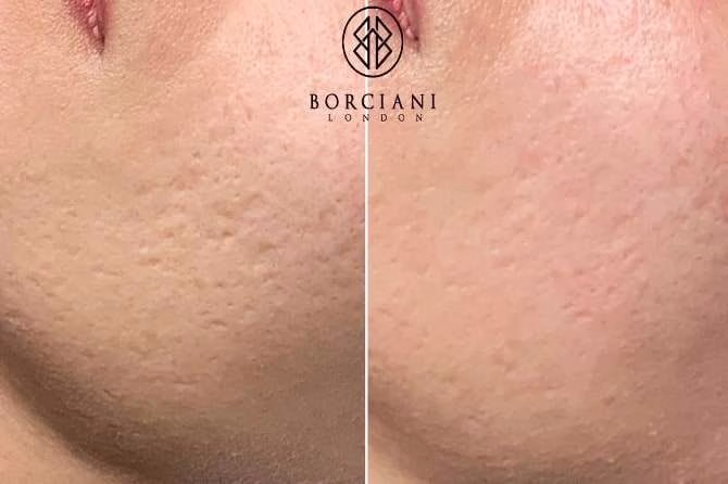 acne3 acne3