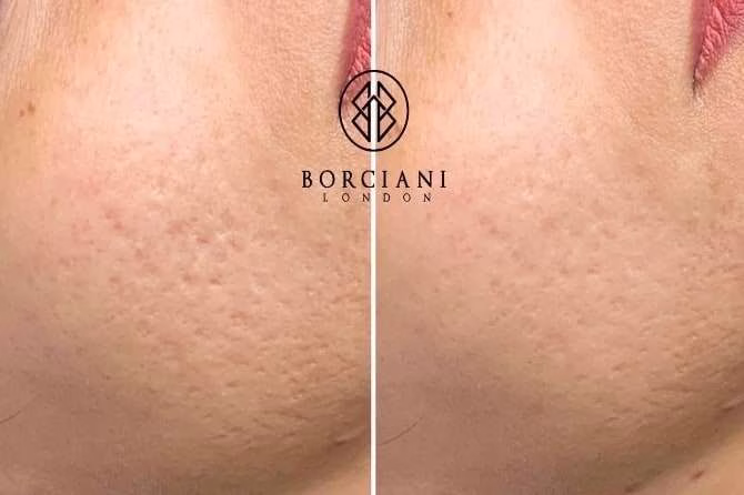 acne4 acne4