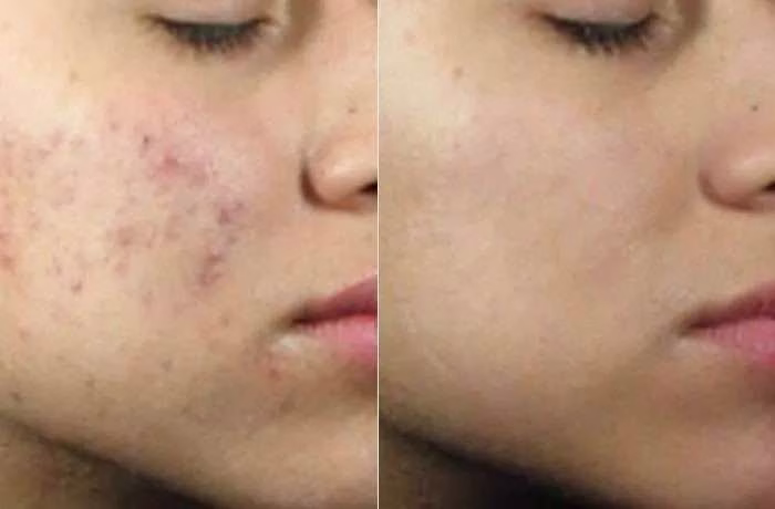acne5 acne5