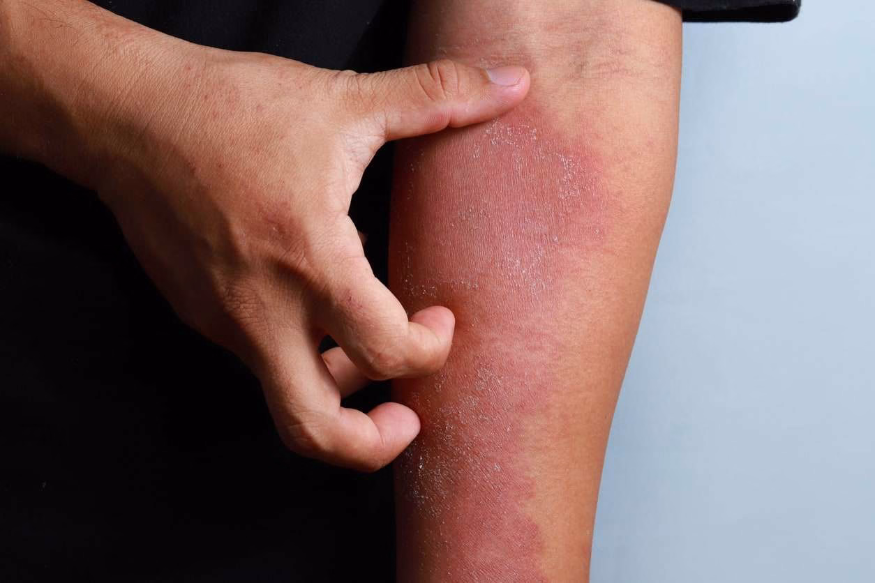eczema.64c966b46bf43