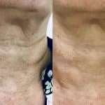 neck2 neck rejuvenation