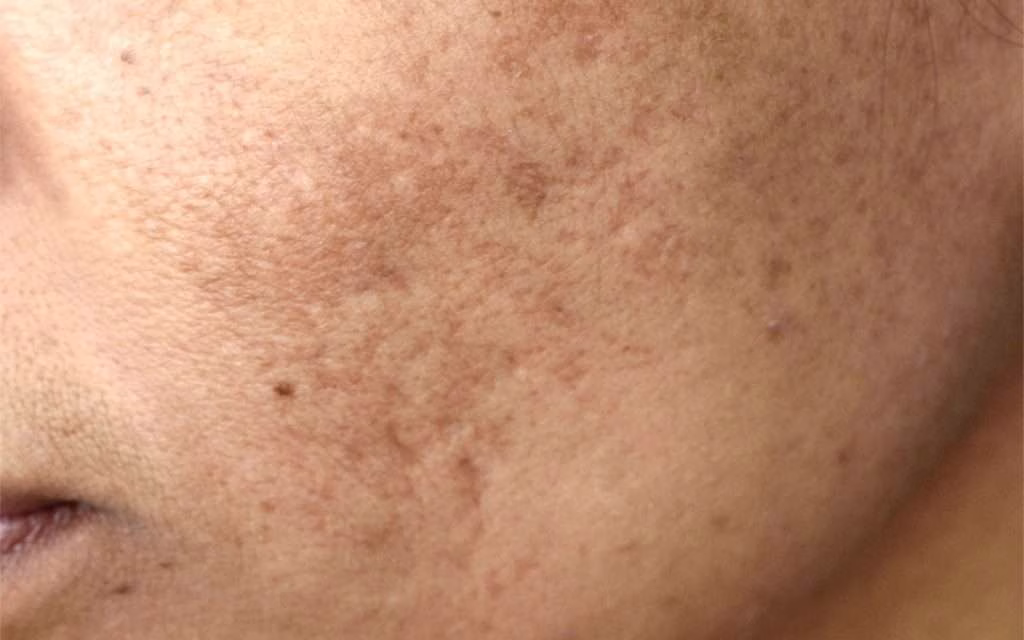 pigmentation acne scar