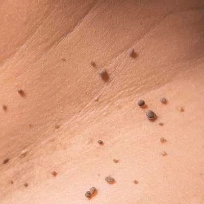 skin-tags-1-1