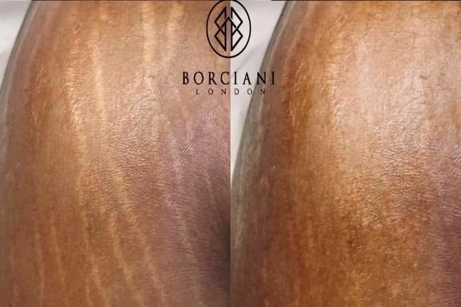 Stretch Marks