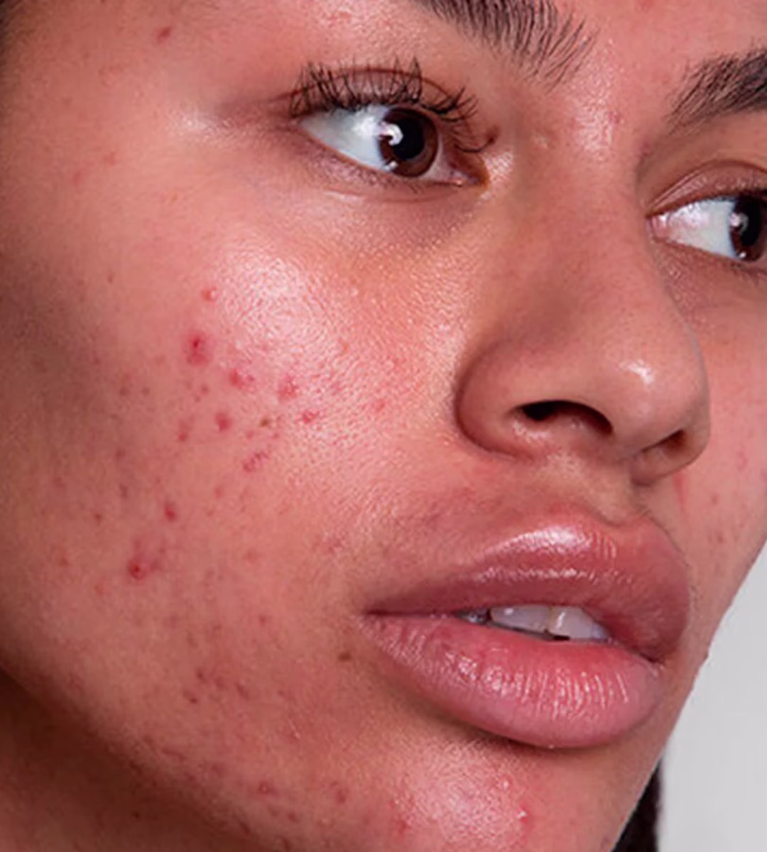 vegan skincare pigmentation treatment