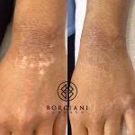 Scar Treatment London