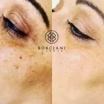 Pigmentation Treatment