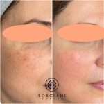 Pigmentation removal