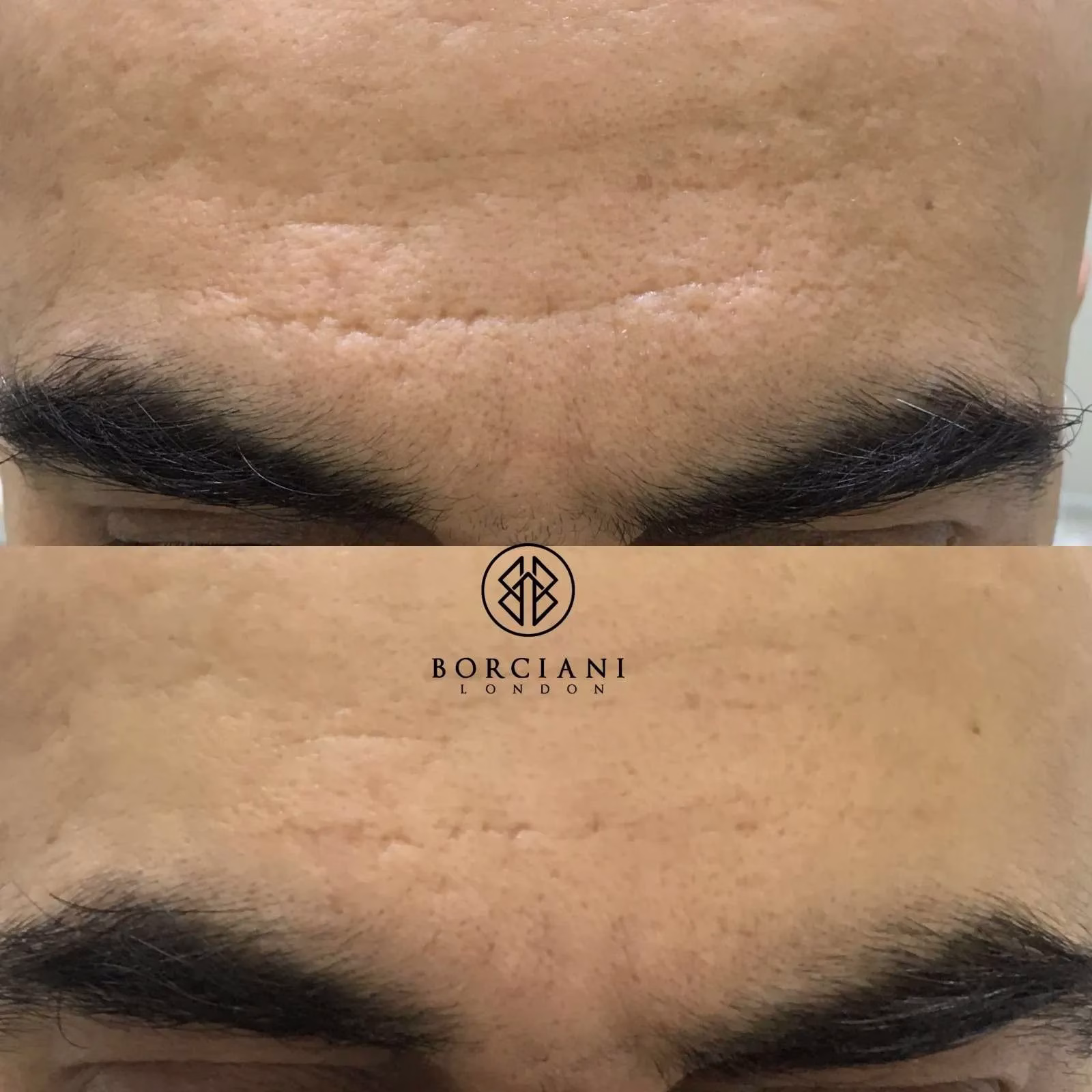 0EAF0707-1B92-427E-95BC-1454E3315A25 Facial scar treatment before and after