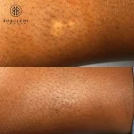 scar camouflage before and after