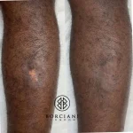Scar camouflage before and after