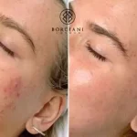 Breakouts and pigmentation