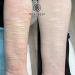 self harm scar before and after CO2