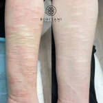 self harm scar CO2 before and after