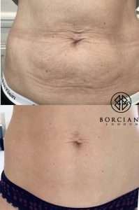 Mummy tummy tightening