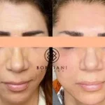 5DFCF4E4-DC9F-4C12-8ABE-FBE85DA57A3A-400x284 Skin Tightening