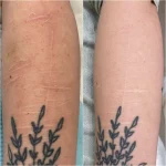 self harm scar before and after Co2