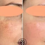 6629ED78-3423-442C-A256-D828C2E8365A-400x284 Pigmentation Treatment