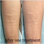 Self harm scar before and after