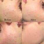 Acne Reduction Treamtnent