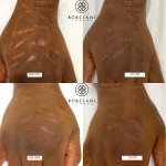 scar camouflage before and after