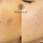 Acne Reduction