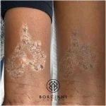 scar camouflage post laser