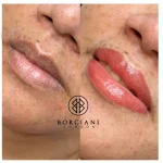 Lip Neutralisation Treatment