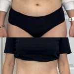 body Tightening and reduction stomach