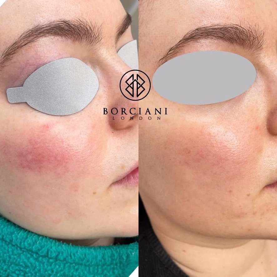 9E290D85-2B9F-4101-84D6-13CB6CCF3F57_1_105_c Thread vein and rosacea