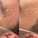 Acne scar reduction