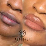 Lip Neutralisation Treatment