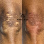scar camouflage before and after
