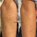 self harm scar before and after